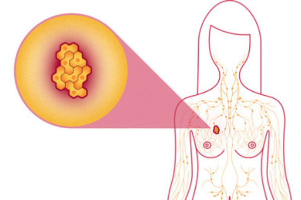 Infographic: Dấu hiệu nhận biết bệnh ung thư vú