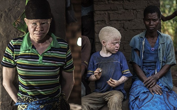 Nỗi khổ của người bạch tạng ở nước Cộng hòa Malawi
