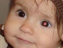 Cảnh báo dấu hiệu ung thư mắt ở trẻ em