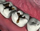 Các bệnh răng miệng nguy hiểm ở người già