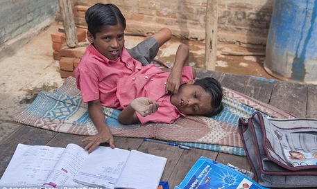 Ấn Độ: Cặp song sinh dính liền thắt lưng không muốn tách rời