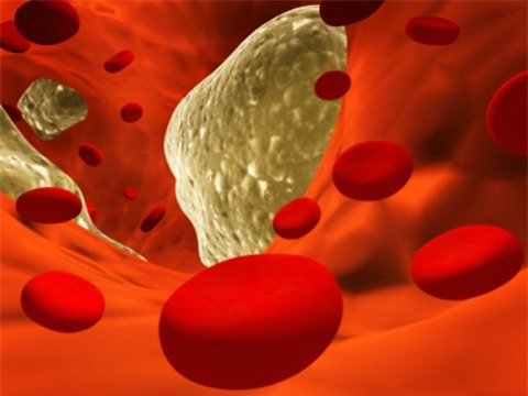 Cholesterol khiến tế bào ung thư di căn nhanh chóng