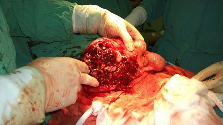 Phẫu thuật thành công cho bệnh nhân có khối u mạc treo phức tạp