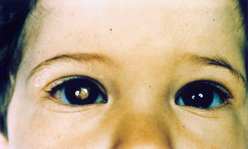 Cậu bé được phát hiện ung thư mắt nhờ bức ảnh mẹ chụp