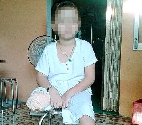 Bệnh viện hỗ trợ 130 triệu đồng vụ bé trai bị cắt cụt chân