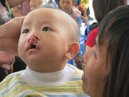 168 trẻ em dân tộc ở Hà Giang được phẫu thuật dị tật miễn phí