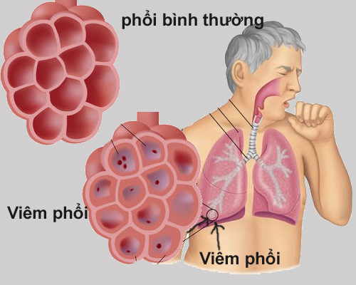 Viêm phổi – Biến chứng nhanh cực nguy hiểm