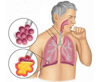 Nhiễm khuẩn đường hô hấp: Bệnh lý phức tạp, khó điều trị