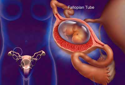mang thai ngoài tử cung: Triệu chứng và cách điều trị