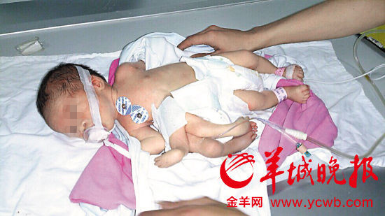 Kỳ lạ bé sơ sinh có 4 chân, 4 tay