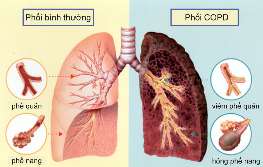 Điều trị hen và phổi tắc nghẽn mạn tính bằng đông y