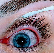Hà Nội: Gần 2.000 trường hợp đau mắt đỏ