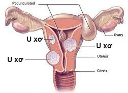U xơ tử cung trong thai kỳ - Rủi ro khó lường