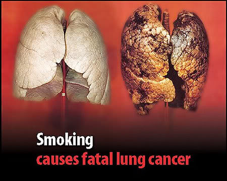 Mỗi năm 1,5 triệu người chết vì ung thư phổi