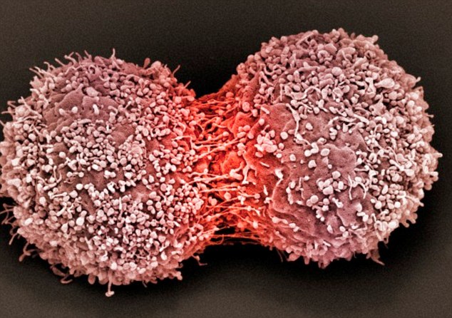 Phát hiện loại gene mới gây ung thư vú
