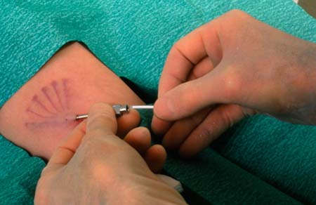 ​Thiết bị ngừa thai hiệu lực lâu hơn mong đợi