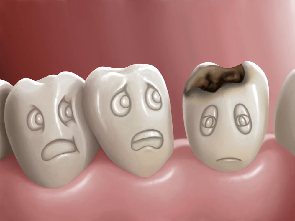 Hàng tỷ người không được chữa trị sâu răng
