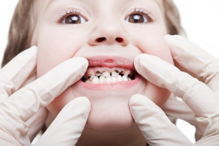 Vì sao răng trẻ bị đen?