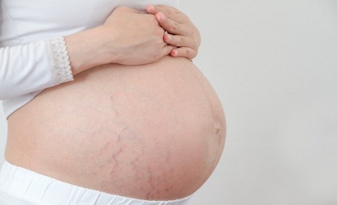 Rạn da khi mang thai phải làm sao?