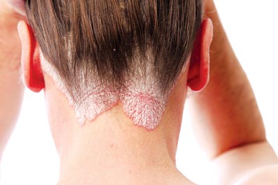 Các bệnh ngoài da có vẩy thường gặp
