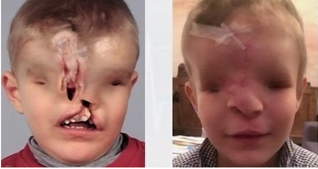 Cậu bé sinh ra không có mắt, mũi được tái tạo khuôn mặt