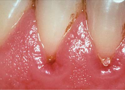 Nhiễm trùng răng miệng do bệnh đái tháo đường