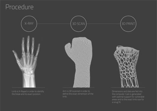Cách mới điều trị gãy xương: Bó bột bằng khung vật liệu in 3D