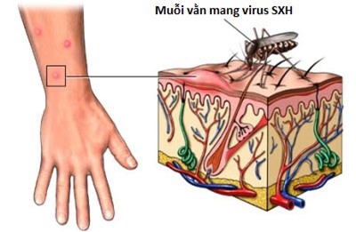 Phát hiện và chăm sóc trẻ sốt xuất huyết tại nhà 1