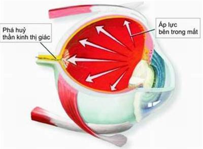 Phòng tránh mù lòa do bệnh glôcôm 1