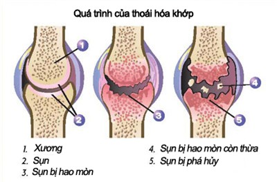 Ăn gì để phòng chữa thoái hóa khớp? 1