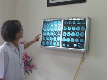 Hình ảnh chụp MRI sọ não (hình bên trái) cho thấy não bị tổn thương nặng vì thiếu oxy.