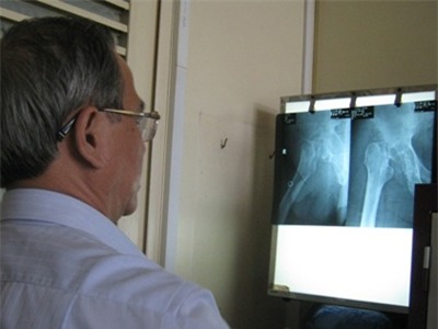 Hình ảnh trên phim cho thấy hai khớp háng của bệnh nhân đã bị mục