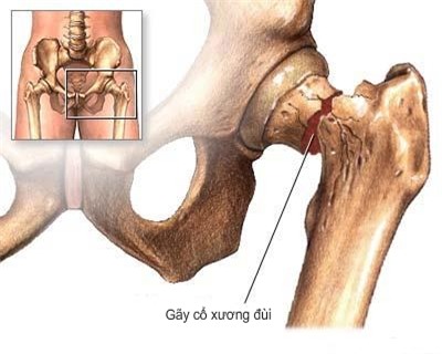 Giải pháp khi bị gãy cổ xương đùi 1