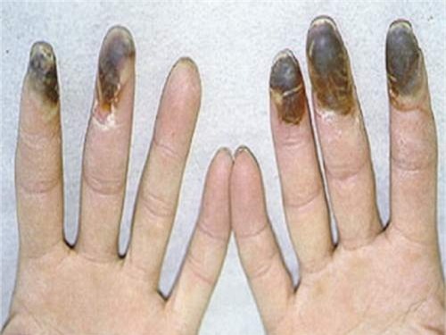 Chẩn đoán hình ảnh tổn thương và các đầu ngón tay hoại tử trong bệnh Buerger