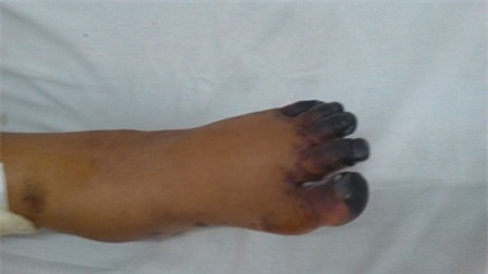 Các ngón chân của bệnh nhân tím đen do hoại tử