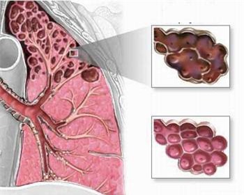 Bệnh hô hấp ở người cao tuổi trong mùa lạnh 2