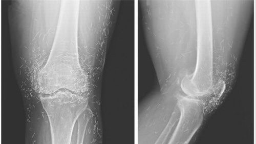 Ảnh. Hình ảnh X-quang cho thấy hàng trăm mũi kim bằng vàng được cho là để lại có chủ đích nhằm mục đích kích thích giảm đau. (livescience.com)