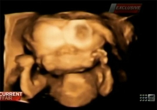 Hình ảnh siêu âm của thai nhi trong tử cung