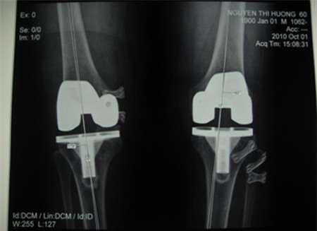 Hình chụp Xquang một bệnh nhân phải thay khớp gối hai bên cùng một lúc. (Ảnh do ThS. BS. Nam Anh cung cấp).