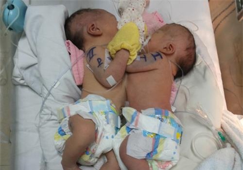 Hai bé song sinh dính liền đang được theo dõi điều trị tại BV Nhi Đồng 1 TP.HCM. Ảnh do bệnh viện cung cấp.