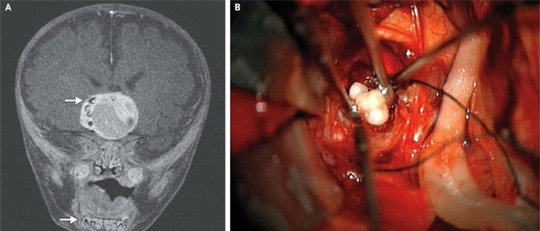 Chiếc răng trong khối u não của bé trai 4 tháng tuổi - Ảnh Live Science