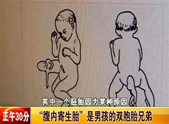 Nếu thai nhi phát triển bé Xiao có thể sẽ mất mạng. Ảnh: v.youku.com
