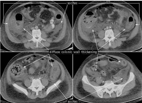 Hình ảnh viêm đại tràng màng giả trên CT scan.