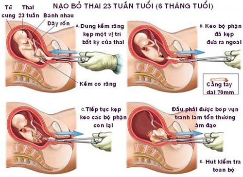 Việt Nam: Phá thai top đầu thế giới! - 2