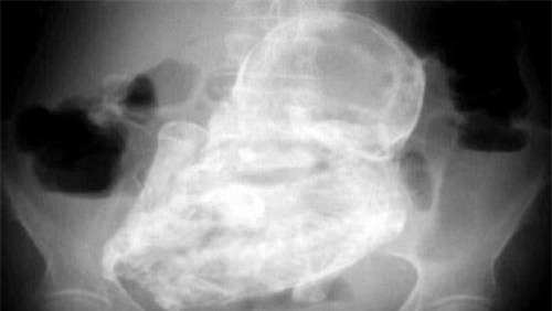 Hình ảnh bào thai hóa đá trong bụng cụ bà 82 tuổi. Ảnh: Dailytelegraph.com.au