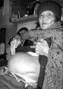 cụ bà Huang Yijun, 92 tuổi ở miền Nam Trung Quốc được phát hiện mang thai đá gần 60 năm. Ảnh: nigerianmonitor