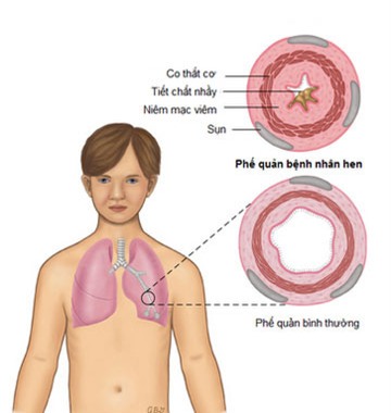 Thuốc cần thiết cho người bệnh hen