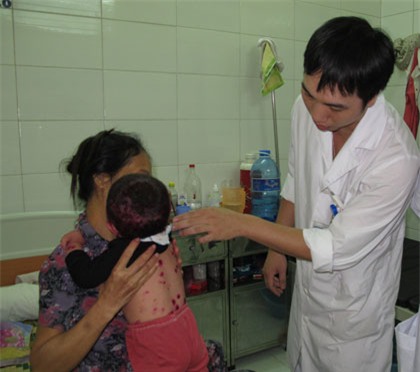 Thăm khám cho bệnh nhân bị thủy đậu tại BV Bệnh Nhiệt đới TW. Ảnh DT