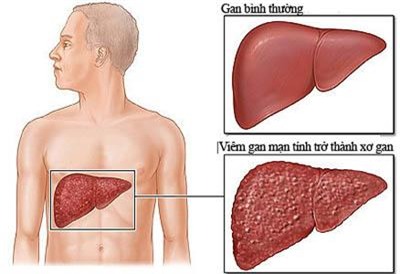 Dấu hiệu báo bệnh ung thư trước 2-5 năm 1