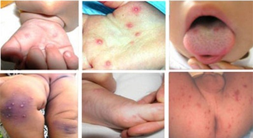Những biến chứng nguy hiểm của bệnh tay chân miệng ở trẻ nhỏ